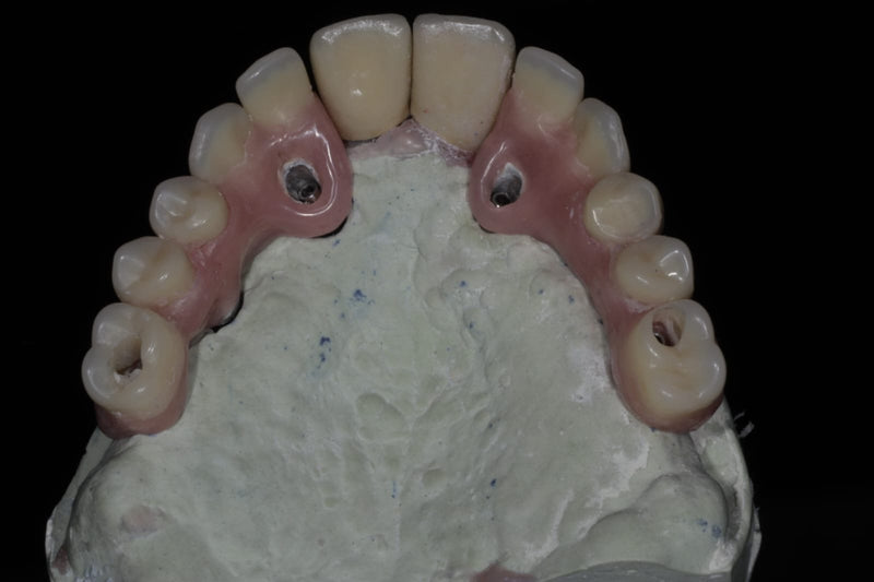 Prótesis sobre implantes